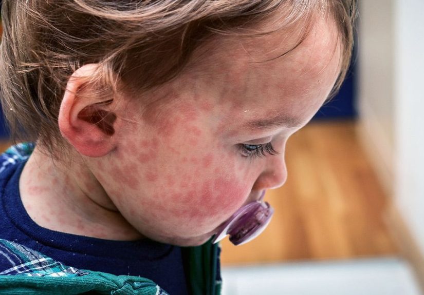 CDC Issues Health Alert As Measles Cases Rise in the US and Globally