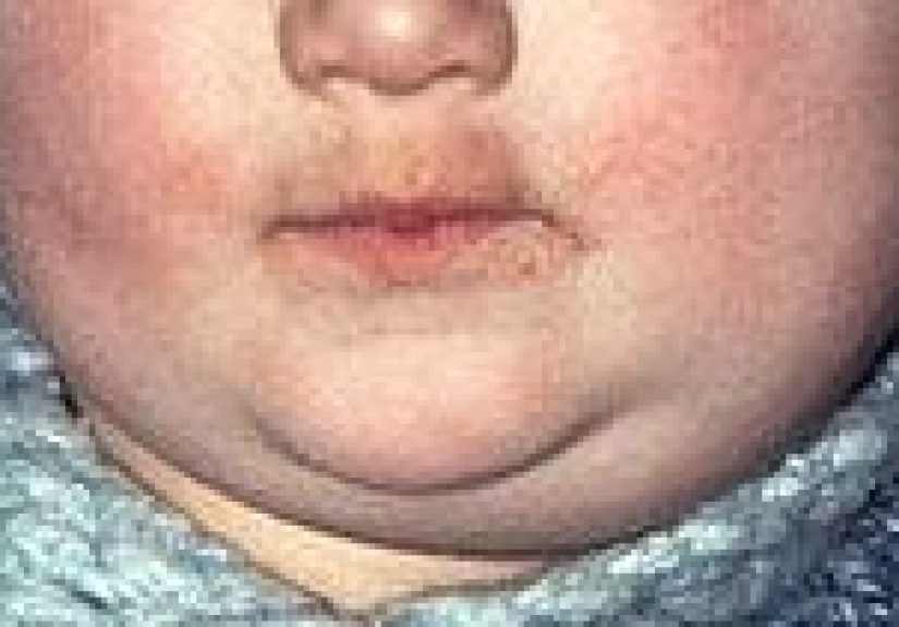 Mumps: Symptoms, Treatments, and Complications