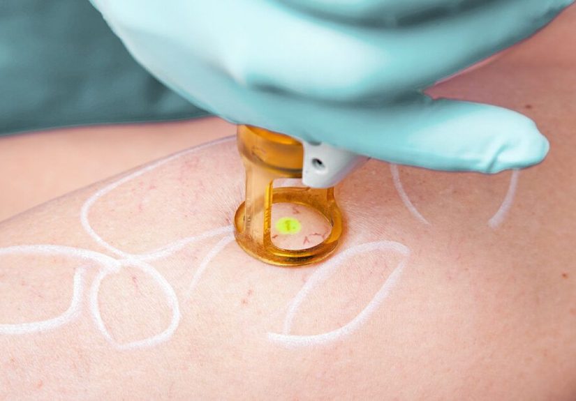 Spider Vein Removal Cost: Average Cost, Insurance Coverage, and More