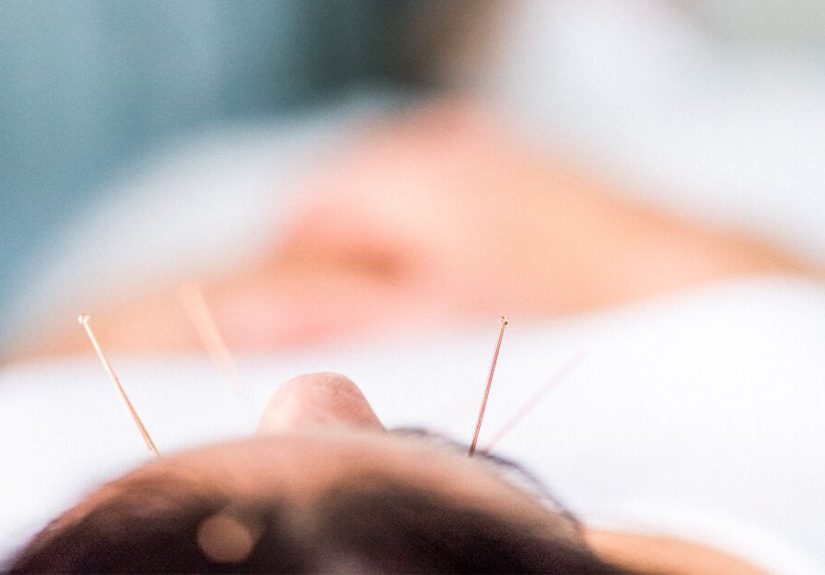 Acupuncture for Depression: Does It Really Work? And 12 Other FAQs