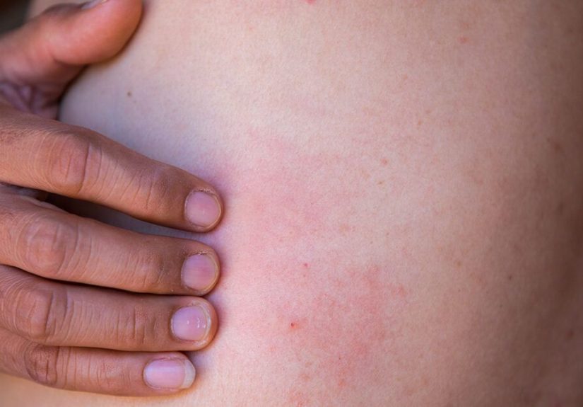 Celiac Disease and Shingles: Are They Connected?
