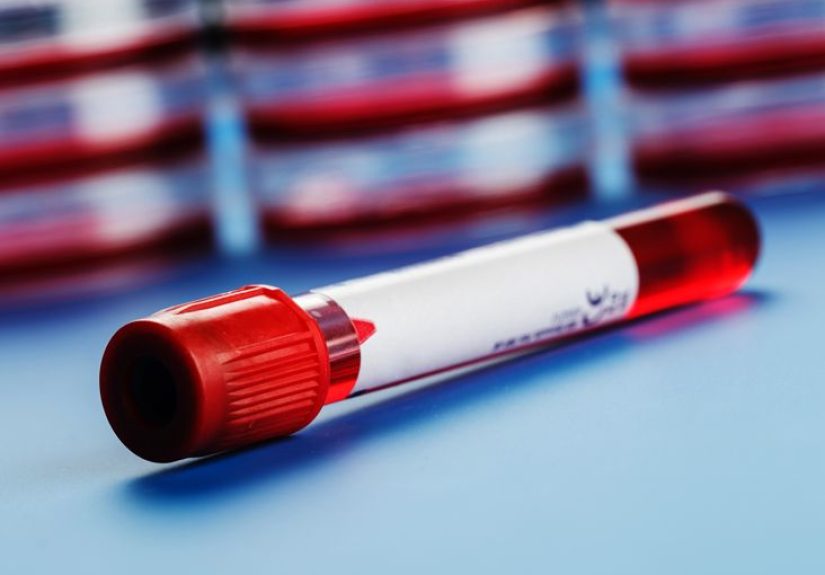 FTA-ABS Blood Test: Purpose, Procedure, and Results