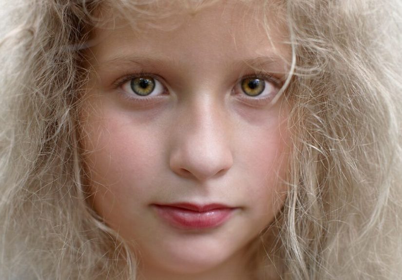 Uncombable Hair Syndrome: Causes, Treatment, and What It Is
