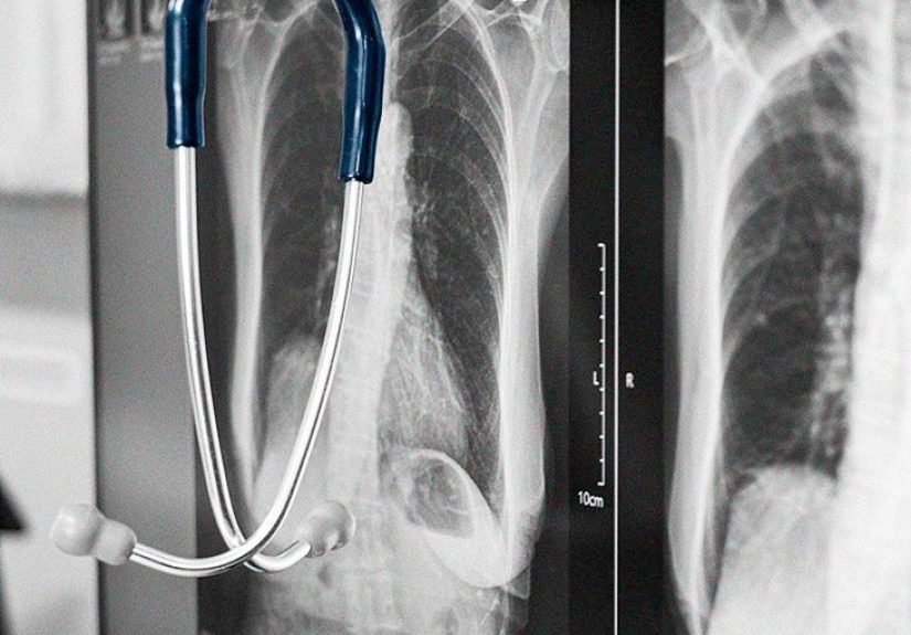 What are the different types of pulmonary embolism?