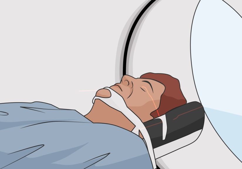 3 Easy Ways to Treat Notalgia Paresthetica