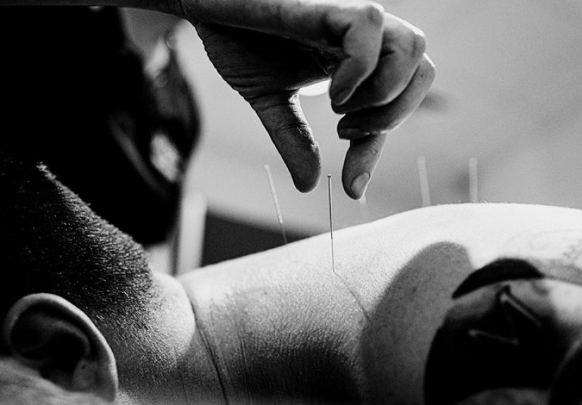 Acupuncture for back pain: Benefits, risks, and procedure