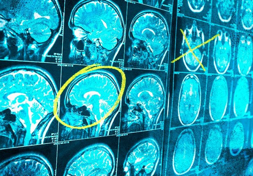 Brain cancer: Types, symptoms, treatments, and more