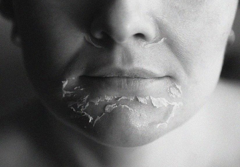 Dry skin: Causes, treatments, prevention, and more