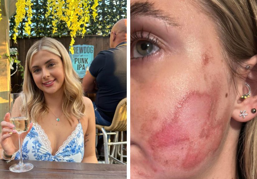 “Horrific”: Woman Suffers Second-Degree Burns After Getting Popular Beauty Procedure