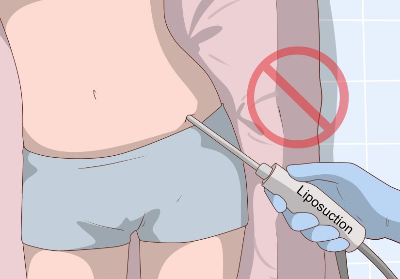 How to Get Rid of Cellulite: Expert Tips