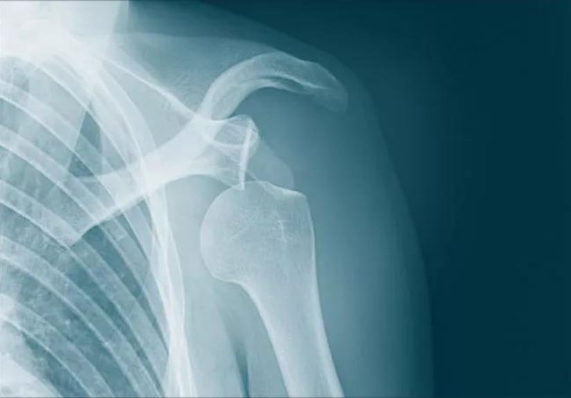 Shoulder Dislocation vs. Subluxation
