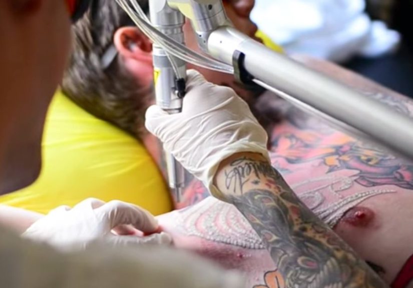 Tattoo Removal: How to, Costs, Before and After Pictures, and More