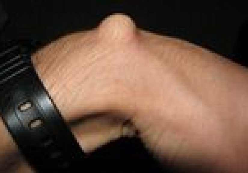 Ganglion Cysts: Symptoms, Causes, and Treatment