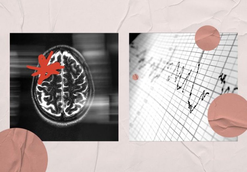 Heart attack and brain damage: Link, symptoms, treatment, recovery