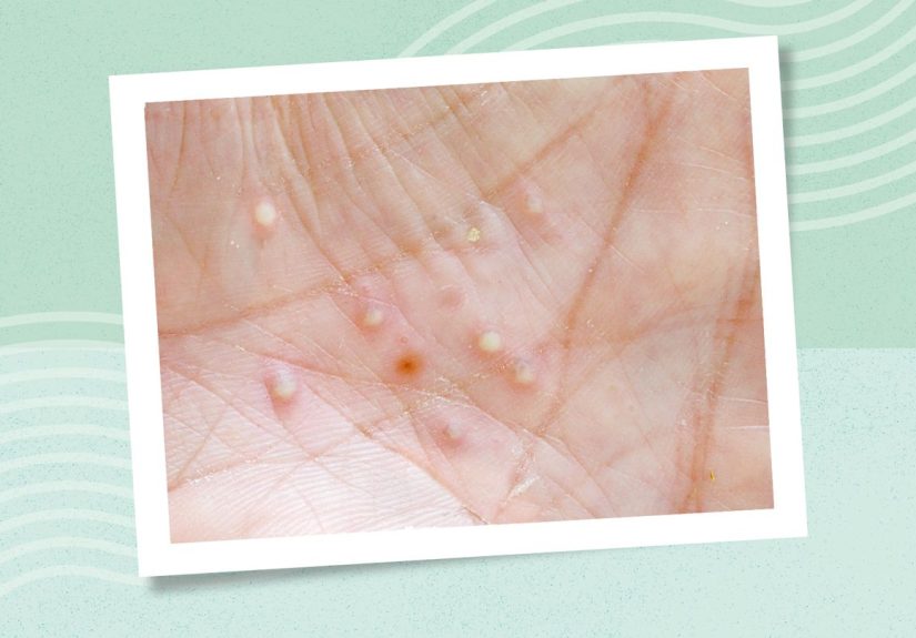Localized Pustular Psoriasis: Symptoms, Causes, and Management