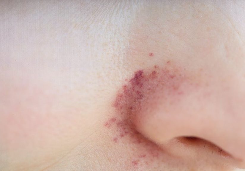 Redness around nose: Causes, treatment, home remedies, and more